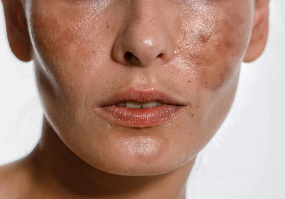Melasma: Entendendo, Tratando e Prevenindo as Manchas na Pele