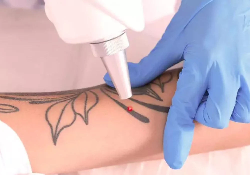 Remoção de Tatuagem: Desvendando o Processo de Transformação da Pele