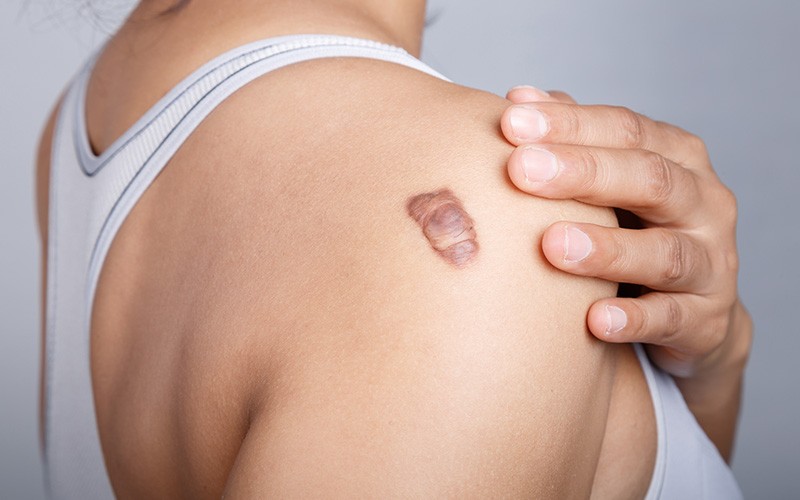 Tratamento de Queloide: Qual o mais indicado?