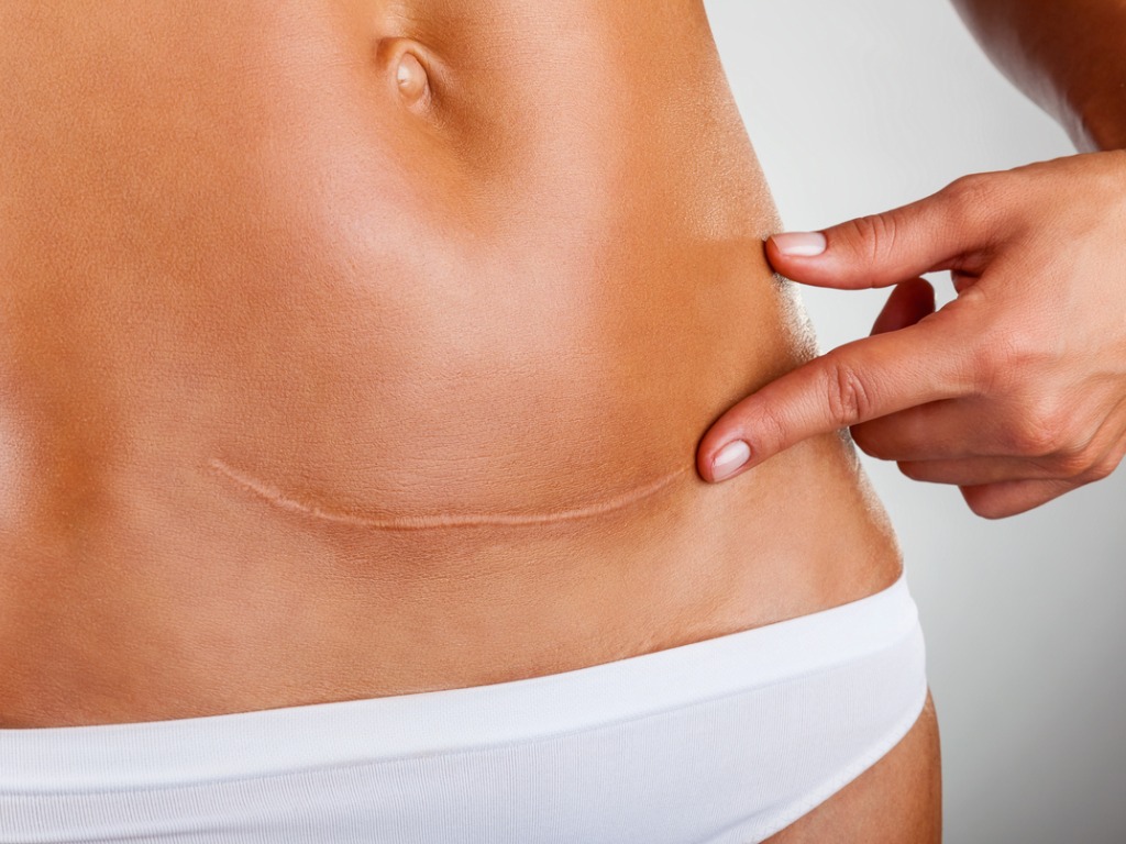 Laser para Cicatrizes: Como Funciona?