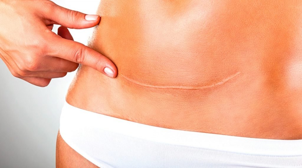 Como é o Tratamento da Cicatriz Hipertrófica