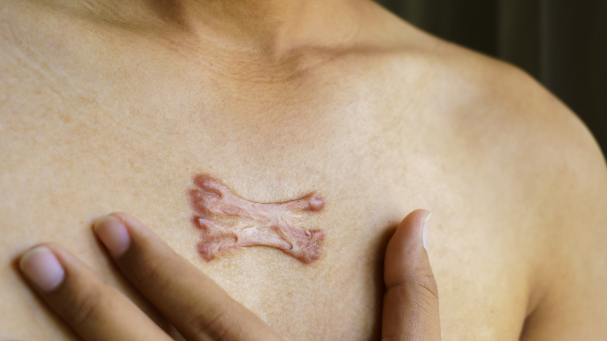 Queloide Como Tirar: Melhores tratamentos contra queloide