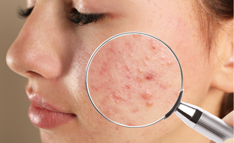 Limpeza de pele profunda para cravos e acne não inflamada