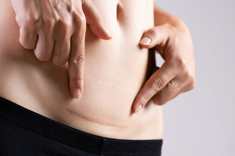 Cicatriz Hipertrófica: Tratamento e Cuidados