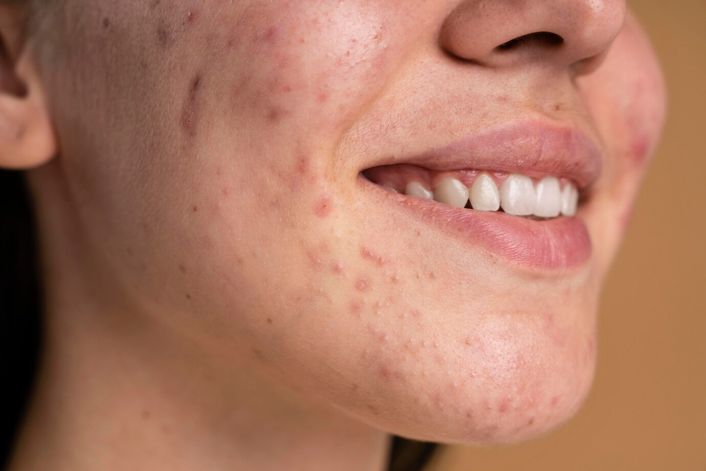 Acne na Pele: Tudo o Que Você Precisa Saber Sobre o Problema Mais Comum
